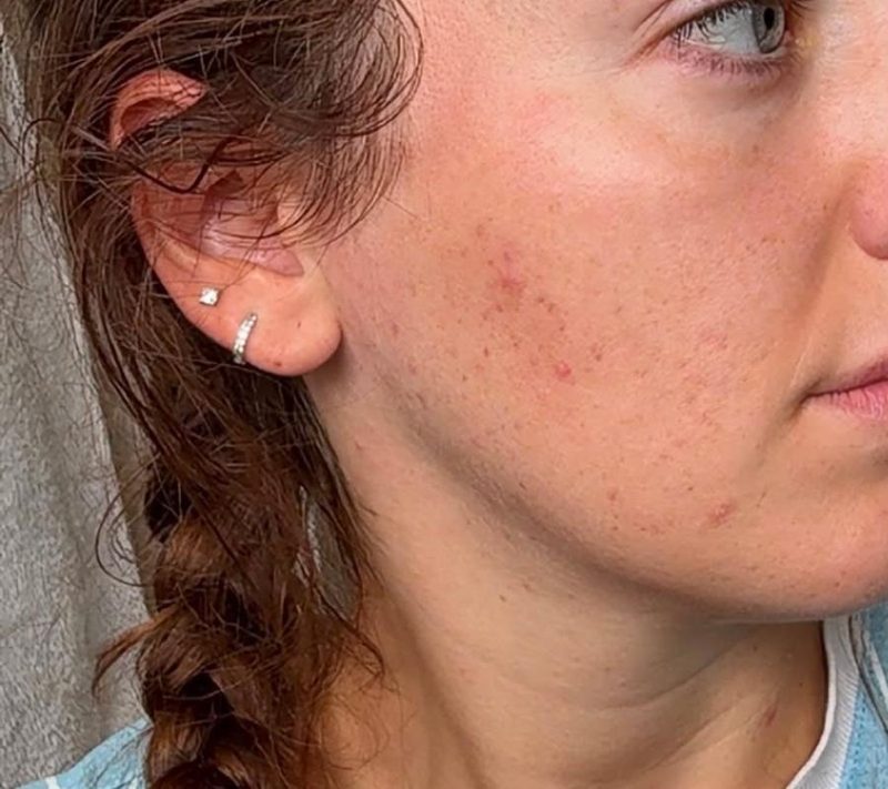 Après : peau apaisée